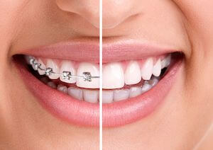 Orthodontic Treatment at Rémi Dental